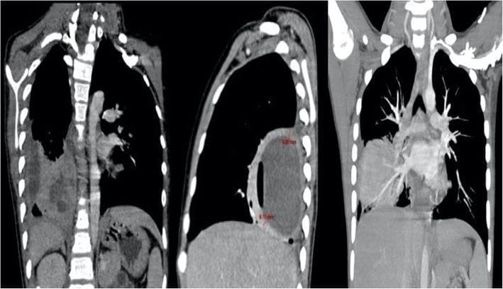 This diagnostic image consists of three thoracic CT scan views (coronal and sagittal) demonstrating cavitated necrotizing pneumonia in the right lower lobe. The primary finding is a large, well-defined lung abscess involving the medial, posterior, and lateral basal segments of the right lung. On the sagittal view, the abscess appears as a large circular lesion with a thick, enhancing wall and a low-density core, with a measurement indicated (approximately 75.7 mm). The coronal views reveal heterogeneous consolidation in the surrounding lung parenchyma and internal lucencies within the main cavity, suggesting multifocal cavitation. Additionally, significant mediastinal lymphadenopathy is visible as enlarged soft-tissue density nodes located in the paratracheal and hilar regions. The pathology shows mass effect on the right hemi-diaphragm. The image serves as an educational example of severe pulmonary tuberculosis complications and secondary bacterial infections (such as Streptococcus anginosus group), highlighting the imaging characteristics of large cavitary lesions and associated reactive or infectious adenopathy.