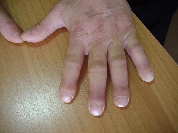 This clinical photograph displays a dorsal view of a human hand resting on a flat surface, illustrating classic features of digital clubbing. The distal phalanges of all visible fingers show significant bulbous enlargement and swelling, resulting in a 'drumstick' appearance. The nails exhibit increased longitudinal and transverse curvature (convexity), becoming rounded and broad. There is a visible loss of the normal angle between the nail plate and the proximal nail fold (Lovibond's angle), with the proximal nail fold appearing thickened and shiny. The skin over the hand is wrinkled, and an old linear scar is noted on the dorsal web space between the thumb and index finger. These findings are highly characteristic of digital clubbing, a clinical sign often associated with chronic hypoxemia, cardiovascular disease, or neoplastic pulmonary conditions such as bronchogenic carcinoma, particularly in patients with a significant smoking history.