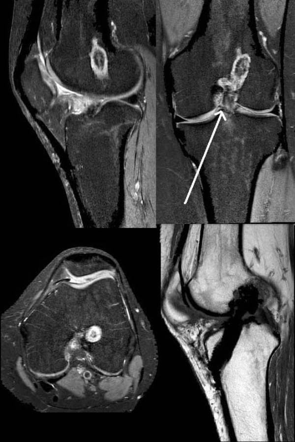 This composite diagnostic image displays multiple MRI views of a human knee joint following anterior cruciate ligament (ACL) reconstruction. The imaging set includes Proton Density-Weighted Fat-Suppressed (PDW FS) sequences in sagittal (top left), coronal (top right), and axial (bottom left) planes, alongside a T1-weighted Turbo Spin Echo (TSE) sagittal sequence (bottom right). The images demonstrate the status of an ACL graft, which appears continuous. A key pathological finding is a focal, low-to-intermediate signal intensity mass located anterior to the ACL graft near the tibial insertion, characteristic of a 'cyclops lesion' (localized anterior arthrofibrosis). This lesion is most clearly demarcated on the sagittal and coronal views (indicated by a white arrow in the coronal plane). The MRI also shows surgical hardware artifacts in the femoral and tibial tunnels. The patellofemoral compartment and joint space are visible across planes to assess for secondary signs of graft dysfunction, such as impingement or altered knee mechanics.
