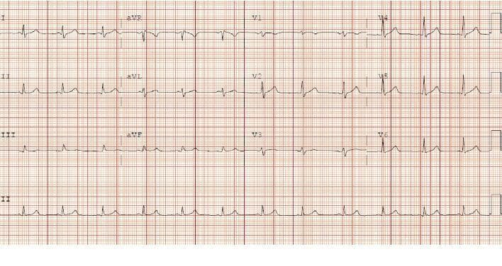 A standard 12-lead electrocardiogram (ECG) printed on standard red-grid thermal paper, demonstrating a normal sinus rhythm. The recording displays the limb leads (I, II, III), augmented leads (aVR, aVL, aVF), precordial leads (V1-V6), and a continuous rhythm strip (Lead II) at the bottom. The cardiac rhythm is regular with a normal rate. P-waves are clearly visible and consistent before every QRS complex, particularly in Lead II, indicating atrial depolarization originating from the sinoatrial node. The PR interval and QRS complex duration appear to be within physiological limits. ST segments are isoelectric across all leads, showing no evidence of acute ST-elevation myocardial infarction (STEMI) or significant ST-depression. T-waves are upright in most leads, reflecting normal ventricular repolarization. This ECG illustrates the successful restoration of sinus rhythm following cardioversion, serving as an educational example of stable cardiac conduction and normal waveform morphology.