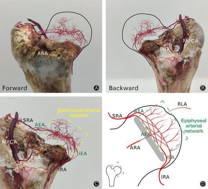 This composite educational resource comprises four panels (A-D) illustrating the complex intraosseous arterial anatomy of the femoral head using a combination of vascular casting and schematic diagrams. Panels A, B, and C present physical macerated bone specimens featuring a red epoxy resin vascular cast of the arterial supply. Panel A (Forward) and B (Backward) show the three-dimensional distribution of the retinacular arteries and the Medial Femoral Circumflex Artery (MFCA). Panel C provides a labeled close-up of the vascular cast, identifying the Superior (SRA), Inferior (IRA), Anterior (ARA), and Posterior (PRA) Retinacular Arteries, as well as the Anterior (AEA) and Inferior (IEA) Epiphyseal Arteries. These vessels converge to form a dense, interconnected 'Epiphyseal arterial network' within the apex of the femoral head. Panel D is a corresponding schematic diagram that maps these vessels and their anastomotic connections, including the Round Ligament Artery (RLA). This content is designed to illustrate the collateral circulation and vascular zones of the proximal femur, critical for understanding the pathophysiology of femoral neck fractures and avascular necrosis (AVN).