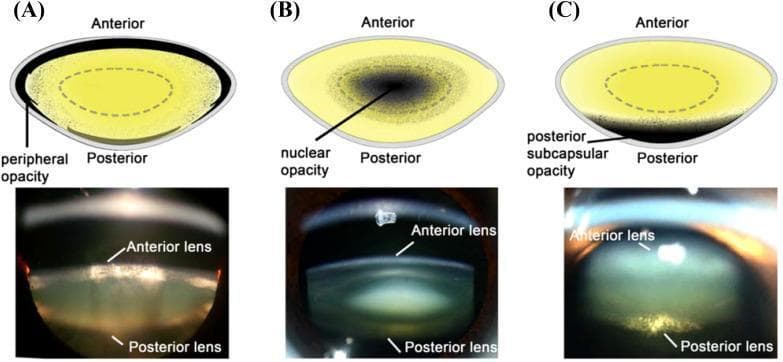 Educational comparison of cataract types featuring schematic diagrams (top row) and Scheimpflug slit-lamp photographic images (bottom row) classified into three categories: (A) Cortical cataract, (B) Nuclear cataract, and (C) Posterior subcapsular cataract.
In the cortical cataract section, the diagram highlights 'peripheral opacity' along the outer lens cortex, mirrored in the slit-lamp image by granular light-scattering in the peripheral layers. The nuclear cataract section demonstrates 'nuclear opacity' concentrated in the central core of the crystalline lens, appearing as a dense, dark focal point in both the illustration and the photographic cross-section. The posterior subcapsular cataract section depicts 'posterior subcapsular opacity' localized just beneath the posterior lens capsule, shown as a distinct white plaque-like reflection at the back of the lens in the clinical image. Each image is annotated with 'Anterior' and 'Posterior' landmarks to orient the observer to the lens anatomy and the depth of the opacification. This visual material is used to teach diagnostic ophthalmology and the pathophysiology of age-related and metabolic lens changes.