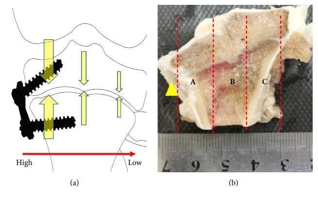 This educational image depicts orthopedic research regarding hemiepiphysiodesis. (a) A conceptual diagram illustrates asymmetric stress distribution across a growth plate following the application of a tension band plate and screws. Vertical arrows represent varying compressive forces, decreasing from the surgical site (high stress) to the opposite side (low stress). (b) A gross clinical photograph displays a coronally sectioned proximal tibia specimen. The specimen is divided into three equidistant regions labeled A (medial/surgical site), B (central), and C (lateral) using vertical dashed red lines. A yellow arrow indicates the surgical site. Visually, regions A and B exhibit increased reddish coloration within the cancellous bone and growth plate area, likely representing vascular response or mechanical irritation, compared to the paler appearance of region C. A metric ruler at the bottom provides a spatial scale for the anatomical divisions. This material is used to demonstrate the morphological changes in the epiphyseal plate in response to localized compressive forces during guided growth procedures.
