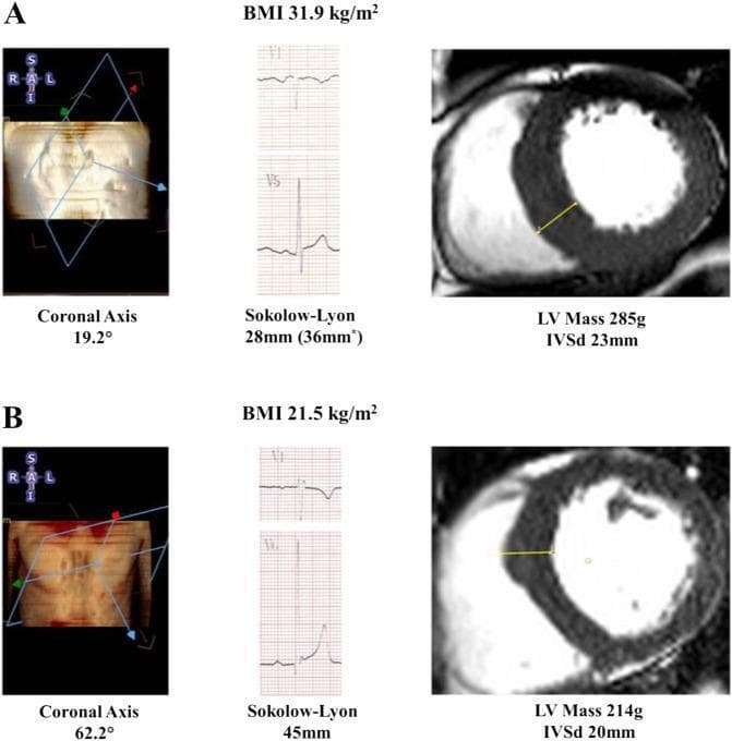 This comparison chart illustrates the impact of Body Mass Index (BMI) and anatomical heart orientation on the diagnostic accuracy of electrocardiogram (ECG) voltage criteria for left ventricular hypertrophy (LVH). The image presents two clinical cases (A and B) featuring three components: a coronal axis scout image, ECG tracings (leads V1 and V5), and cardiac magnetic resonance (CMR) short-axis views. Case A (BMI 31.9 kg/m²) demonstrates a leftward-deviated coronal axis of 19.2°, resulting in a falsely negative Sokolow-Lyon voltage (28mm) despite a high LV mass (285g) and thickened intraventricular septum (IVSd 23mm) on CMR. Case B (BMI 21.5 kg/m²) shows a more vertical coronal axis of 62.2° with a positive Sokolow-Lyon voltage (45mm) and a lower LV mass (214g). The diagram highlights how obesity-related anatomical shifts and increased chest wall distance can attenuate ECG surface voltages, potentially masking pathological hypertrophy. Key educational concepts include the correlation between thoracic anatomy, BMI, and the sensitivity of Sokolow-Lyon criteria in detecting CMR-verified LVH.