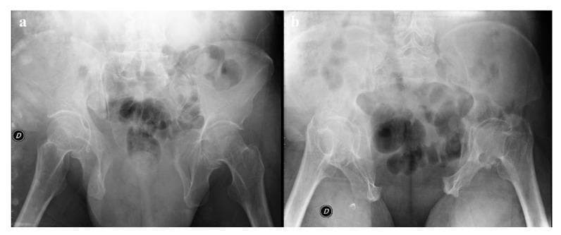 Two anteroposterior plain radiographs of the human pelvis demonstrating specific trauma-focused projections: (a) an outlet view and (b) an inlet view. The images reveal a significant disruption of the anterior pelvic ring, characterized by a pubic symphysis diastasis measuring approximately 5.2 cm. In the inlet view (b), there is also visible anterior widening of the left sacroiliac (SI) joint, indicating a disruption of the posterior pelvic arch. These radiographic findings are consistent with an unstable pelvic ring injury, likely an Anteroposterior Compression (APC) Type II or III injury according to the Burgess-Young classification system. The outlet view specifically assists in evaluating craniocaudal displacement and sacral morphology, while the inlet view highlights the anteroposterior translation and rotational deformity of the hemipelvis. These projections are critical in orthopedic trauma for assessing pelvic stability and planning surgical fixation.