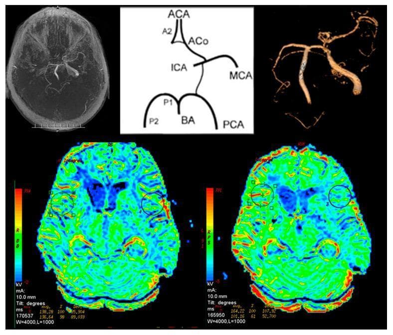 This composite diagnostic image illustrates intracranial vascular anatomy and cerebral perfusion dynamics in a patient with internal carotid artery (ICA) stenosis. The top row features three panels: a grayscale axial Magnetic Resonance Angiogram (MRA) showing the Circle of Willis, a schematic anatomical diagram labeling the major arteries (ACA, A2, ACo, ICA, MCA, P1, P2, BA, PCA), and a 3D-reconstructed angiogram highlighting significant asymmetry in the cerebral vasculature. The bottom row displays two axial Perfusion MRI (P-MR) maps using a colorimetric scale, where blue/green indicates lower perfusion and red/orange indicates higher perfusion. These maps compare baseline cerebral blood flow with post-Acetazolamide challenge images. Circular Regions of Interest (ROI) are marked on both cerebral hemispheres to quantify perfusion changes. The Acetazolamide-challenged map (right) demonstrates a reduction in cerebrovascular reserve in the affected hemisphere, characterized by a lack of compensatory hyperemic response compared to the contralateral side. This educational material is relevant for neuroradiology and neurology, specifically for evaluating hemodynamic compromise in patients with high-grade carotid artery occlusion.