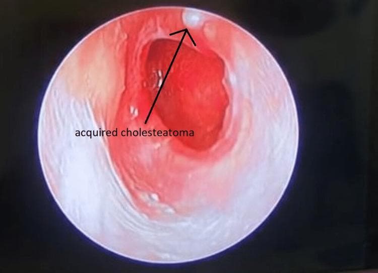 This clinical photograph, likely obtained via otoscopy or endoscopic ear examination, demonstrates an acquired cholesteatoma within the external auditory canal. The view reveals a significant area of pathological change characterized by intense erythema and inflammation of the canal wall and tympanic membrane region. A hallmark finding is the presence of a small, white, keratinous debris mass (cholesteatoma) located at the superior aspect of the canal, indicated by an arrow. The surrounding mucosal tissue appears thickened and irregular, suggesting chronic irritation or infection. The central portion of the field shows a deep red hue and compromised tissue integrity, typical of middle ear pathology extending into the canal. This image is an educational resource for identifying the visual hallmarks of primary acquired cholesteatoma, specifically the retraction pocket formation and the accumulation of squamous epithelial debris in the attic or pars flaccida region.