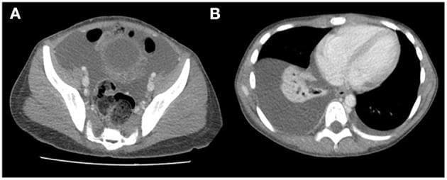 This clinical imaging figure consists of two axial CT scan slices (A and B) demonstrating systemic fluid overload manifestations. Image A is a cross-sectional view of the abdomen/pelvis showing significant ascites, characterized by low-density fluid collection surrounding the bowel loops and internal organs. Additionally, there is marked subcutaneous edema in the lumbar and abdominal wall regions, appearing as thickened, spongy tissue with increased density compared to normal fat. Image B is a thoracic CT slice showing bilateral pleural effusions. The right-sided effusion is more prominent, presenting as a large, crescent-shaped, low-density fluid accumulation in the posterior and lateral pleural space, resulting in compressive atelectasis of the adjacent lung parenchyma. The left side shows a smaller rim of pleural fluid. These findings are clinically significant for pathologies causing severe hypoalbuminemia or generalized edema, such as Menetrier's disease or protein-losing enteropathy. The content is suitable for medical students and radiologists to recognize the visual signs of polyserositis and soft tissue edema on computerized tomography.