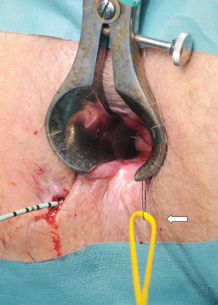 This clinical photograph captures an intraoperative view of a surgical procedure for a complex fistula-in-ano. A metallic Parks or similar anal retractor is positioned to provide exposure of the anal canal. The surgical field demonstrates the management of a fistula track using specialized instrumentation. On the left side of the image, a urological guidewire with black and white markings is seen entering the external fistula opening, which shows minor associated hemorrhage. A yellow vascular sling (indicated by a white arrow) is being threaded through the track using a 1/0 nylon suture loop. The educational focus of the image is the technique of passing a vascular sling from the internal opening to the external opening to serve as a loose seton. This procedure is critical in colorectal surgery for maintaining drainage of the fistulous track while preventing abscess formation and protecting the anal sphincter muscles. The image is intended for intermediate to advanced medical learners focusing on proctological surgical techniques.