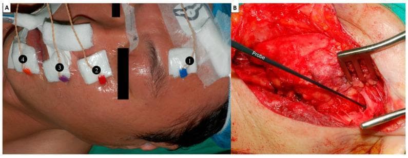 Two-panel clinical photograph illustrating an intraoperative facial nerve (FN) monitoring setup. (A) Lateral view of a patient's face showing the placement of four paired subdermal needle electrodes for electromyography (EMG) recording. The electrodes are secured with white gauze and transparent tape at four anatomical sites corresponding to FN branches: 1) lower forehead (temporal branch), 2) infraorbital area (zygomatic branch), 3) superolateral upper lip (buccal branch), and 4) inferolateral lower lip (marginal mandibular branch). Connectors are color-coded (blue, red, purple, orange) for channel identification. (B) Intraoperative view of a parotid gland dissection. A black 1.0 mm ball-tip monopolar stimulating probe is positioned within the surgical field to identify the FN trunk via electrical localization. Surgical retractors are visible, exposing the deep tissue layers. This setup demonstrates the methodology for continuous neural monitoring to prevent iatrogenic nerve injury during head and neck surgery.