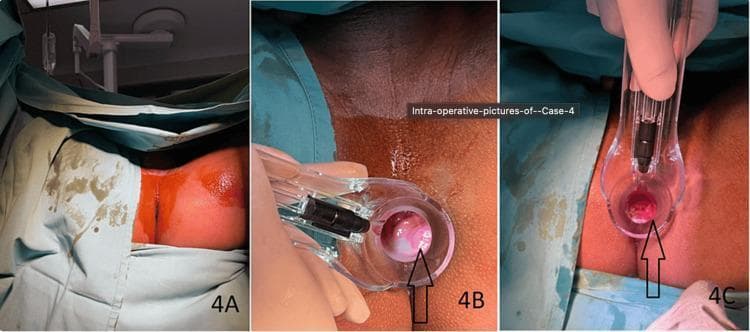 This composite of three clinical photographs documents an intraoperative RAFAELO procedure for internal hemorrhoids. Panel 4A shows the preoperative surgical field with the patient in a prone or lithotomy position, draped with green surgical sheets. The perianal skin is prepped with an orange-tinted antiseptic solution. Panel 4B displays an intraoperative proctoscopy view using a clear plastic proctoscope. A black arrow identifies a prominent, erythematous, fleshy Grade II internal hemorrhoid cushion protruding into the rectal lumen at the 5 o'clock position. Panel 4C shows the post-procedure proctoscopy view following radiofrequency ablation. The targeted hemorrhoidal tissue (indicated by the arrow) appears visibly reduced in volume, less edematous, and significantly more retracted compared to the preoperative state. These images serve as educational material for colorectal surgery, illustrating the visual markers of successful radiofrequency treatment for symptomatic internal hemorrhoids.