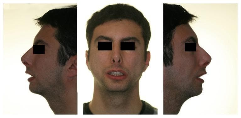 Post-operative clinical photographs of a 23-year-old male patient with Moebius syndrome, presented in three panels: a right profile view, a frontal view, and a left profile view. The images demonstrate the aesthetic and functional outcomes of orthognathic surgery, including mandibular advancement, genioplasty, and lip augmentation via fat injection. In the profile views, there is a corrected convex profile with increased chin projection and a more defined jawline, addressing pre-operative severe micrognathia. The frontal view shows improved lip symmetry and enhanced lip volume, aimed at correcting congenital lip incompetence and reducing interlabial separation at rest. The primary educational focus is the multidisciplinary management of craniofacial dysmorphism and facial nerve palsy manifestations through surgical and orthodontic intervention.