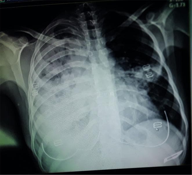 This diagnostic image is an anteroposterior (AP) chest X-ray demonstrating significant bilateral pulmonary pathology. The primary findings include diffuse, hazy opacities and patchy infiltrates throughout both lung fields, with a higher concentration and increased density in the upper lobes. Notably, the left upper lung zone exhibits lucent areas suggestive of cavitation within a region of dense consolidation. The right lung also shows extensive infiltrative changes. The cardiac silhouette is partially obscured by the adjacent pulmonary densities. Osseous structures, including the ribs and clavicles, appear intact without evidence of acute fractures or destructive lesions. Radiopaque EKG leads are visible on the chest wall. Clinically, such a pattern of cavitary lesions and upper lobe infiltrates is characteristic of chronic granulomatous infections such as pulmonary tuberculosis, or progressive malignancies like Hodgkin lymphoma with pulmonary involvement. This image serves as a key educational example for recognizing complex parenchymal lung disease and identifying cavitary features on plain film radiography.