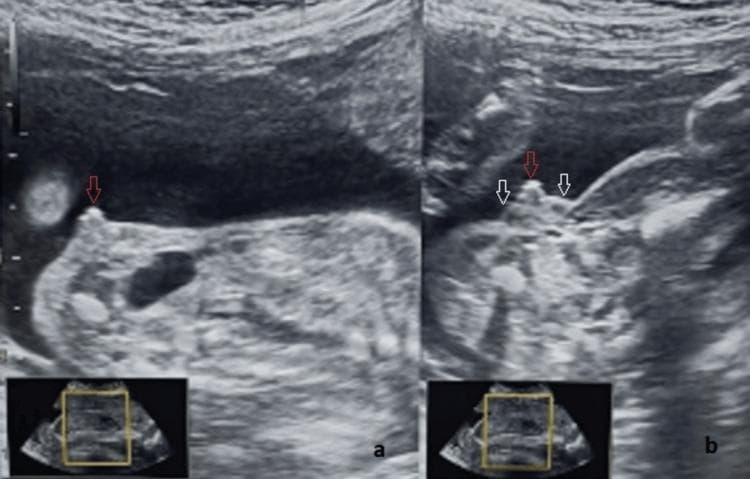 This diagnostic ultrasound illustrates fetal clitoromegaly and labial hypertrophy at 25 weeks of gestation, a key finding in the evaluation of ambiguous genitalia and congenital adrenal hyperplasia. Image (a) provides a sagittal view, highlighting a significantly thickened and prominent clitoris (indicated by a red arrow) protruding from the genital region. Image (b) presents an axial view of the same anatomy, where the enlarged clitoris (red arrow) is flanked by two distinct, hypoechoic, and homogenous labial swellings (white arrows). These findings demonstrate a departure from the normal 'three-line sign' of female genitalia, with the outer labial lines appearing divergent and convex rather than parallel. The imaging modality is B-mode prenatal sonography. This case is educationally significant for distinguishing between female genital virilization and severe male hypospadias during prenatal screening, emphasizing the importance of multi-planar assessment (sagittal and axial) and the identification of internal pelvic organs like the uterus for accurate sex determination.