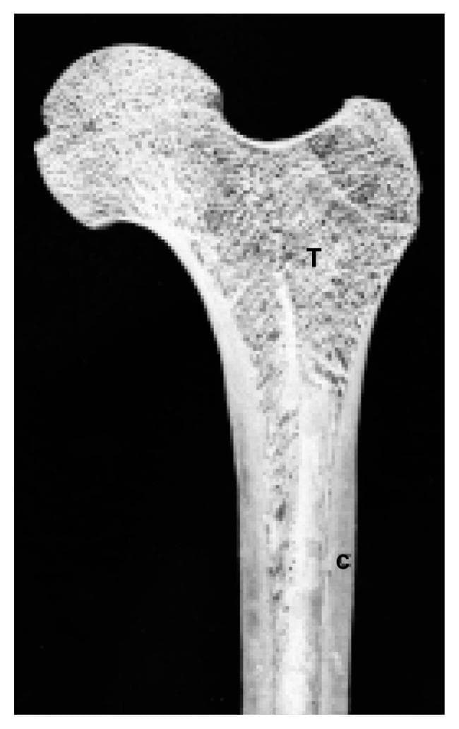 This diagnostic image is a longitudinal section of the proximal femur, illustrating the macrostructure of human long bones. The anatomical region shown includes the femoral head, neck, and the superior portion of the femoral shaft. Two distinct bone types are labeled for educational comparison. The area labeled 'C' represents the cortical bone (compact bone) forming the thick, dense outer walls of the diaphysis. It is characterized by a solid, uniform radiopaque appearance with high density and structural rigidity. The area labeled 'T' identifies the cancellous bone (spongy or trabecular bone) concentrated within the epiphysis and metaphysis. This region displays a characteristic porous, meshwork-like organization consisting of thin plates and interconnected trabeculae. The visual highlights the transition between the load-bearing cortical shell and the internal honeycomb-like support system of the femur, providing an anatomical basis for understanding bone physiology and structural integrity in orthopedics and endocrinology.