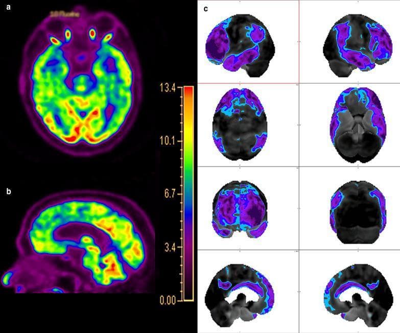 This diagnostic image displays Fluorodeoxyglucose (FDG) PET/CT brain imaging of a 68-year-old male presenting with personality changes, characteristic of Frontotemporal Dementia (FTD). Panel (a) shows an axial view and panel (b) shows a sagittal view using a rainbow color scale to map metabolic activity. These views demonstrate marked hypometabolism (purple/blue) in the frontal and temporal lobes, while metabolic activity is relatively preserved (green/yellow/red) in the parietal and occipital lobes, including the precuneus and posterior cingulate cortex (PCC). Panel (c) presents Single-Subject Statistical Parametric Mapping (ss-SPM) results. This analysis highlights significant negative deviation from control mean uptake values, visualized as blue and purple clusters overlaying brain templates across multiple slices (sagittal, axial, and coronal). The ss-SPM confirms a characteristic FTD pattern: predominant hypometabolism in the anterior cingulate and frontal regions compared to the posterior cingulate. This imaging profile serves as an educational example of how FDG-PET and quantitative SPM analysis can differentiate FTD from other neurodegenerative conditions like Alzheimer's disease.