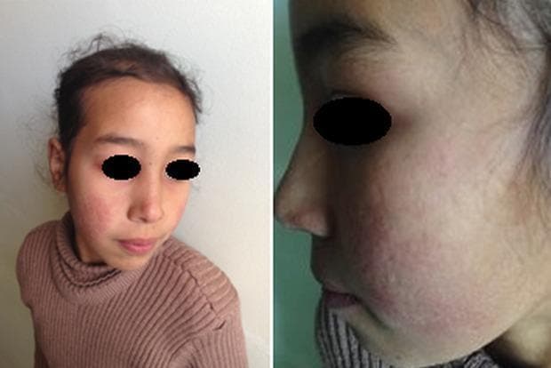 This clinical photograph displays a pediatric patient with dermatological manifestations consistent with Systemic Lupus Erythematosus (SLE). The image consists of two panels: a frontal view and a lateral close-up of the face. A distinctive malar rash, often referred to as a 'butterfly rash,' is visible across the nasal bridge and bilateral cheeks, notably sparing the nasolabial folds. The affected skin exhibits erythematous discoloration and an irregular texture. Higher magnification reveals atrophic scarring within the malar region, characterized by thin, slightly depressed skin with altered pigmentation. The forehead and peri-orbital regions appear relatively unaffected. These visual features are classic diagnostic markers for lupus-related skin involvement, illustrating the chronic inflammatory and sequela phases of the disease. The content is relevant for medical students and clinicians studying rheumatology, dermatology, and autoimmune connective tissue disorders.