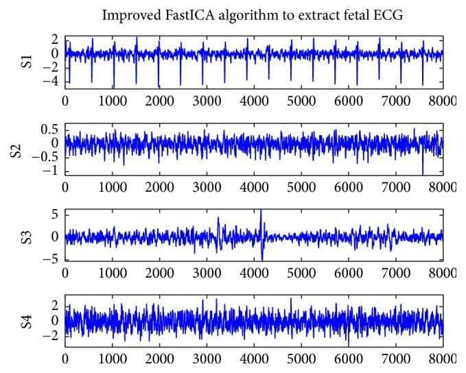 This diagnostic visualization displays four signal waveforms (labeled S1 through S4) generated by an improved FastICA algorithm for the extraction of fetal electrocardiogram (ECG) data from maternal abdominal recordings. Each plot represents a different signal component after maternal ECG cancellation. The S1 signal demonstrates a clear fetal ECG pattern characterized by sharp, negative-amplitude R-wave deflections occurring at a regular heart rate; these spikes reach approximately -4 units against a stable baseline. In contrast, signals S2, S3, and S4 represent residual noise or non-target components with varying amplitudes and frequencies but lack the distinct, periodic fetal cardiac complexes seen in S1. S2 shows low-amplitude fluctuations between -1 and 0.5, S3 displays higher-amplitude non-periodic spikes between -5 and 5, and S4 exhibits dense baseline noise between -2 and 2. The image illustrates the clinical application of signal processing in fetal monitoring to isolate high-quality fetal cardiac data from complex physiological noise.