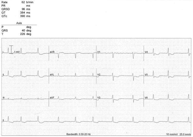A 12-lead electrocardiogram (ECG) demonstrating an irregularly irregular rhythm consistent with atrial fibrillation at a rate of 62 beats per minute. The QRS complexes are narrow (duration 96 ms) with a frontal axis of 40 degrees. Notable findings include global, downsloping ST-segment depression most prominent in the precordial leads (V3-V6) and inferior leads (II, III, aVF). Lead aVR shows reciprocal ST-segment elevation. The T-waves are generally upright except for an inversion in aVR, with a calculated T-wave axis of 226 degrees. These morphological features, specifically the 'scooped' ST-segment depression in a patient with atrial fibrillation and bradycardia, are classic indicators of digoxin effect or toxicity. The ECG parameters at the top indicate a QTc interval of 390 ms. The image is captured at a standard calibration of 10 mm/mV and a paper speed of 25.0 mm/s.