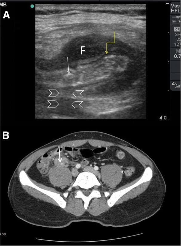 This composite figure demonstrates the diagnostic imaging of acute appendicitis via Point-of-Care Ultrasound (POCUS) and Computed Tomography (CT).
Image A is a high-frequency linear probe ultrasound showing a cross-section of a thickened, non-compressible appendix. Key features include a hypoechoic, edematous muscularis propria (indicated by a yellow arrow) and an intraluminal hyperechoic appendicolith/faecolith (white arrow) exhibiting prominent posterior acoustic shadowing (arrowheads). A localized anechoic fluid collection (marked 'F') surrounds the inflamed appendix, consistent with periappendiceal fluid or a phlegmon.
Image B is an axial CT scan of the abdomen and pelvis with intravenous contrast, confirming the ultrasound findings in the right iliac fossa. It shows a dilated appendix with wall enhancement and an associated hyperdense faecolith (white arrow) situated anterior to the psoas muscle.
This comparison illustrates the utility of POCUS in identifying classic sonographic signs of appendicitis—wall thickening, fecaliths with shadowing, and periappendiceal fluid—and its correlation with definitive CT imaging in a clinical setting of fever and right lower quadrant pain.