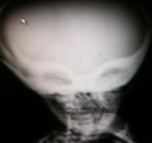 Anteroposterior facial skull radiograph demonstrating generalized osteosclerosis, a hallmark of osteopetrosis. The image reveals a significant increase in bone density throughout the craniofacial skeleton, with marked involvement of the skull base, sphenoid bones, and orbital margins. This dense sclerotic appearance of the orbits and sphenoid wings creates a characteristic 'Harlequin mask' sign. The cervical vertebrae are partially visible at the bottom of the frame, showing increased radiopacity consistent with 'bone-in-bone' appearance. This diagnostic image illustrates key radiographic manifestations of marble bone disease, highlighting the pathological failure of osteoclast-mediated bone resorption. Such findings are critical for diagnosing metabolic bone disorders in pediatric and adult radiology, particularly where diffuse skeletal hyperostosis is present.
