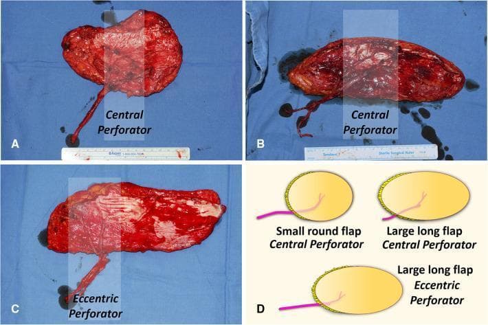 This composite educational graphic details variations in the design of Anterolateral Thigh Perforator (ALTP) flaps for soft tissue reconstruction. The image consists of clinical photographs of harvested specimens (A, B, C) and a corresponding schematic diagram (D).
Panels A and B demonstrate Cen-ALTP flaps, where the vascular pedicle enters the skin paddle centrally. Image A shows a small, round paddle with a shorter pedicle, while Image B displays a significantly elongated, larger paddle. Panel C illustrates an Ecc-ALTP flap, featuring a large, long skin paddle with the perforator vessel located eccentrically toward one end. The clinical photographs show the raw, vascularized deep surface of the flaps and the length of the dissected vascular pedicles. Panel D provides an illustrative summary of these three configurations, emphasizing how perforator location (central vs. eccentric) and paddle dimensions (small round vs. large long) are varied to accommodate different recipient site requirements and pedicle reach. These flaps are commonly used in reconstructive surgery for large defects such as those following debridement for chronic osteomyelitis in the lower limb.