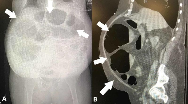This composite diagnostic image demonstrates severe colonic dilatation in a 76-year-old male patient, consistent with Ogilvie syndrome (acute colonic pseudo-obstruction). Image A is an anteroposterior abdominal radiograph (X-ray) showing marked gaseous distention of the large bowel loops, particularly in the right and transverse colon segments. The haustral markings are visible but stretched, indicating significant intramural pressure. Image B is a sagittal view from a computed tomography (CT) scan with oral contrast, revealing a massively dilated transverse colon segment abutting the anterior abdominal wall. White arrows in both images highlight the most severely distended areas. The CT scan confirms the lack of a mechanical obstructing lesion and shows the relationship between the dilated bowel and the peritoneum. These findings illustrate typical radiological features of massive non-obstructive colonic dilatation, a critical finding in postoperative patients presenting with abdominal distension and vomiting. Educational focus includes distinguishing mechanical versus functional bowel obstruction through multi-modal imaging.