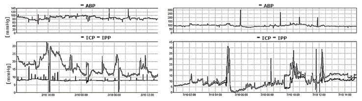A comparative medical waveform display illustrating intracranial pressure monitoring dynamics in a patient with subarachnoid hemorrhage. The visual is divided into two clinical states: 'Drain Opened' (left panels) and 'Drain Closed' (right panels). The top row monitors Arterial Blood Pressure (ABP) in mmHg, while the bottom row provides a dual-trace of Intracranial Pressure (ICP) via an External Ventricular Drain (EVD) and Intraparenchymal Pressure (IPP). When the EVD is open (left), the ICP trace remains a horizontal constant representing the drainage level relative to the heart, showing no correlation with the fluctuating IPP. When the EVD is closed (right), the ICP and IPP traces become synchronous and highly correlated, reflecting shared intracranial dynamics. The graphic demonstrates the clinical importance of clamping an EVD to obtain accurate, comparable physiological intracranial pressure measurements. This monitoring is critical for managing cerebral perfusion pressure (CPP) and detecting elevated ICP that may lead to cerebral ischemia or herniation in neurocritical care settings.