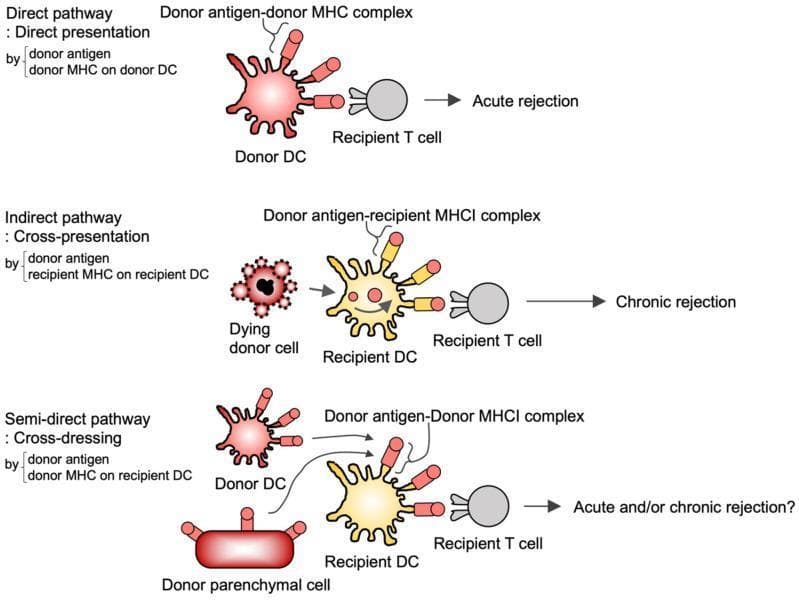 A pathophysiology diagram illustrating three pathways of alloreactive T cell activation in the context of allograft transplantation: direct, indirect, and semi-direct. 1) Direct Pathway (Direct Presentation): A red Donor Dendritic Cell (DC) presents donor antigen-donor MHC complexes directly to a Recipient T cell, leading to acute rejection. 2) Indirect Pathway (Cross-presentation): A dying donor cell is phagocytosed by a yellow Recipient DC, which then presents donor antigen-recipient MHCI complexes to a Recipient T cell, promoting chronic rejection. 3) Semi-direct Pathway (Cross-dressing): Recipient DCs acquire preformed donor antigen-donor MHCI complexes from donor DCs or donor parenchymal cells via trogocytosis (membrane transfer). The cross-dressed Recipient DC then interacts with a Recipient T cell, potentially leading to acute and/or chronic rejection. The diagram uses color-coded cells (red for donor, yellow for recipient, grey for T cells) and labeled molecular complexes to distinguish between direct recognition of alloantigens and recipient-mediated antigen processing.