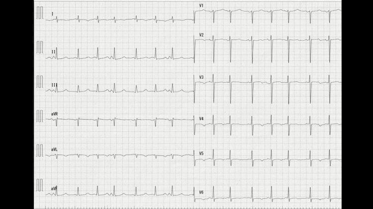 A standard 12-lead electrocardiogram (ECG) showing a regular sinus rhythm at approximately 75 beats per minute. The primary diagnostic finding is a prolonged QT interval, with a corrected QT (QTc) calculated at 458 ms. The limb leads (I, II, III, aVR, aVL, aVF) demonstrate relatively normal axis and morphology, though the T waves appear notably tall and peaked in multiple leads. In the precordial leads (V1-V6), the QRS complexes remain narrow with a normal R-wave progression and a transition zone occurring between V3 and V4. The ST segments are isoelectric without significant elevation or depression. The tall, peaked T waves and prolonged QTc interval are the most prominent educational features, which in this clinical context may be associated with metabolic disturbances such as hypocalcemia or primary hypoparathyroidism. This ECG serves as a visual reference for diagnosing interval abnormalities and T-wave morphology variations in an acute clinical setting.