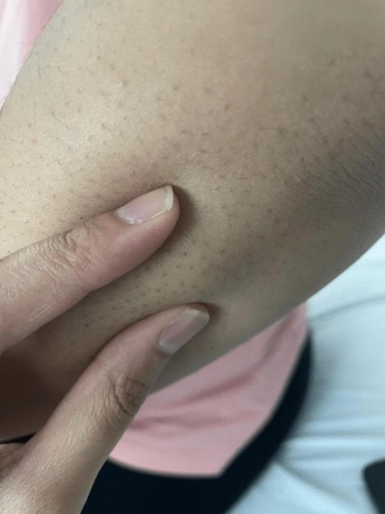 This clinical photograph displays a close-up view of the right upper extremity, specifically the extensor surface of the elbow region. The primary clinical finding is the presence of multiple, small subcutaneous nodules. These nodules appear as firm, rounded, non-tender-looking elevations beneath the skin surface, typically measuring less than 1 cm in diameter. The overlying skin is intact, displaying normal pigmentation and texture without visible erythema, warmth, or ulceration. Prominent hair follicles are visible as dark punctate spots across the skin. In a clinical context involving polyarthralgia and carditis, these nodules are a major Jones criterion for the diagnosis of acute rheumatic fever (ARF). This image serves as a teaching tool for medical students and clinicians to recognize the dermatological manifestations of systemic streptococcal-related diseases and rheumatological disorders.