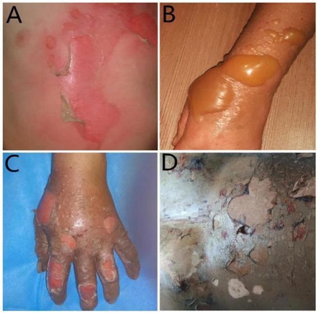 A composite of four clinical photographs demonstrating the progression and classification of burn wound severity. Image A illustrates a first-degree (superficial) burn, showing blanching erythema of the skin with areas of peeling epidermis. Image B depicts a superficial second-degree (partial-thickness) burn on an extremity, characterized by large, tense, fluid-filled bullae with translucent amber-colored serous fluid and surrounding erythematous inflammation. Image C shows a deep second-degree burn on the hand, featuring mottled red and white tissue with ruptured blisters and areas of exposed dermis. Image D represents a third-degree (full-thickness) burn, displaying a dry, leathery, and inelastic eschar with a variegated color palette of white, grey, and brown, indicating destruction of the epidermis, dermis, and subcutaneous tissue. This comparison chart serves as a diagnostic educational tool for identifying burn depth based on visual morphological features such as blistering, tissue color, and texture.