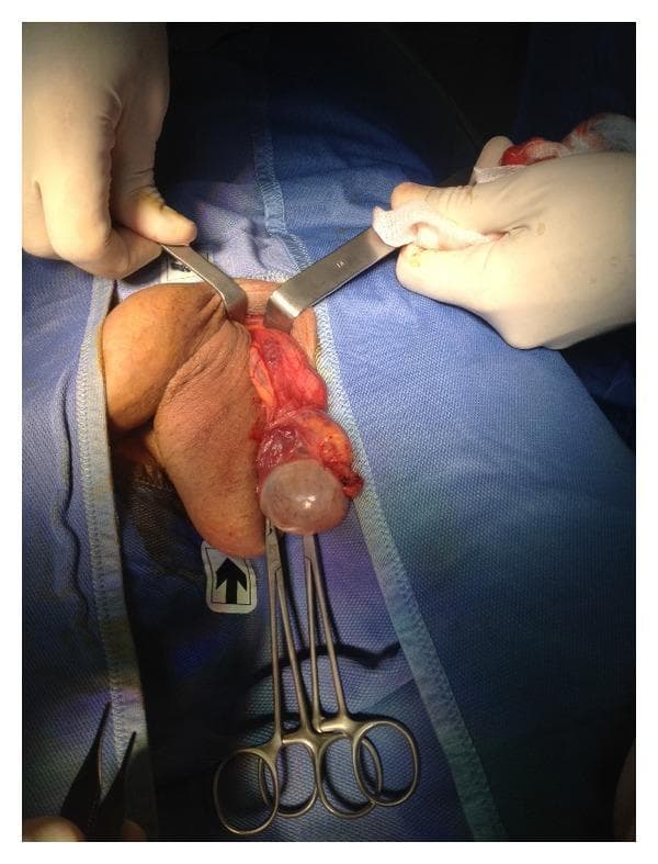 This clinical photograph illustrates an intraoperative view of an open scrotal surgical procedure focusing on the left testis and spermatic cord. The patient is positioned supine, with the surgical field isolated by blue drapes. A pair of Farabeuf retractors is used to widen the scrotal incision, exposing the underlying dartos fascia and spermatic cord. The primary finding is a translucent, fluid-filled cystic structure, identified as a hydrocele of the tunica vaginalis, which is being manipulated with surgical clamps. The testis and associated vascular structures of the cord are visible. The procedure demonstrates the resection and eversion of the tunica vaginalis, a common surgical technique for hydrocele repair (hydrocelectomy). The image serves as an educational resource for urological surgery, specifically highlighting anatomical landmarks such as the external inguinal ring, the spermatic cord, and the relationship between the tunica vaginalis and the testis during surgical intervention.