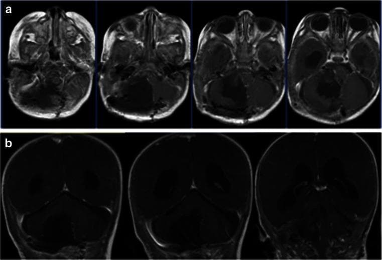 Diagnostic post-operative MRI scans of a pediatric patient following surgical resection of an atypical teratoid/rhabdoid tumor (ATRT). The image consists of two rows: (a) axial T1-weighted post-contrast sequences and (b) coronal T1-weighted post-contrast sequences. The images demonstrate a significant resection cavity in the right posterior fossa, specifically within the right cerebellar hemisphere, extending toward the cerebellopontine angle (CPA). There is a notable absence of abnormal contrast enhancement, indicative of a gross total resection with no immediate evidence of residual tumor tissue. The brain parenchyma in both the infratentorial and supratentorial compartments appears relatively symmetrical, and the ventricular system shows normal morphology and size without signs of hydrocephalus. Bony structures of the skull base remain intact, though post-surgical changes related to the posterior fossa craniotomy are visible. This imaging illustrates successful radical surgical management of a high-grade pediatric brain tumor.