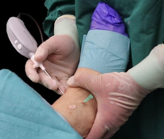 Clinical photograph illustrating the external setup of a minimally invasive ankle arthroscopy. The image shows a surgeon's gloved hands performing the procedure on a prepped ankle joint. A 2-mm diameter arthroscope, attached to a handheld control unit with a white casing, is introduced via the anteromedial portal. A green-hubbed hypodermic needle is inserted laterally to mark and localize the anterolateral portal for secondary instrument access. The surgical site is prepared with an antiseptic solution and isolated using blue sterile drapes, while the distal foot is covered with a purple sterile wrap. The educational focus is on the correct anatomical positioning of standard arthroscopic portals (anteromedial and anterolateral) and the use of small-caliber (2-mm) instrumentation in orthopedic sports medicine. This visualization demonstrates the external coordination required for joint insufflation and instrument triangulation during diagnostic or therapeutic ankle surgery.