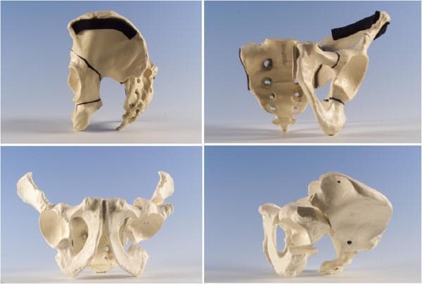 This composite of four clinical photographs displays a three-dimensional anatomical bone model of the human pelvis, specifically illustrating the technique for an Interlocking Pelvic Triple Osteotomy used in treating hip dysplasia. The images show the pelvic girdle from multiple orientations (lateral, posterior-oblique, anterior, and superior-oblique views) to highlight the three specific osteotomy sites required to mobilize the acetabulum. Key surgical cuts include: 1) a three-sided iliac osteotomy extending from the iliac crest towards the acetabulum; 2) an ischial osteotomy performed through the sub-cotyloid groove near the obturator foramen; and 3) a superior pubic ramus osteotomy. The model demonstrates how these strategic bone cuts allow for the reorientation of the acetabular fragment to improve lateral femoral head coverage and correct anteversion. The sacrum and pelvic landmarks such as the iliac crest, acetabulum, and pubic symphysis are clearly visible, providing anatomical context for the orthopedic procedure.