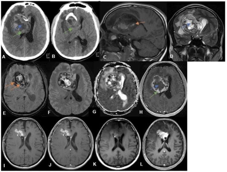 A comprehensive longitudinal radiological panel consisting of CT and MRI sequences (A-L) documenting the progression of a right intraventricular tumor. Pre-operative imaging (A-H) reveals a large, heterogeneous mass occupying the frontal horn and body of the right lateral ventricle. The lesion exhibits internal calcifications on axial CT (A, B), T1-hypointensity (C), and T2-hyperintensity (D) with evident cystic/necrotic areas (blue arrows), hemorrhagic foci on SWI (E, orange arrows), and a solid peripheral component (green arrows) showing restricted diffusion on DWI/ADC (F, G) and prominent post-contrast enhancement on T1 (H). Associated findings include perilesional edema and obstructive hydrocephalus with sulcal effacement. Post-operative axial T1 images (I, J) demonstrate gross total resection with residual subacute blood products in the resection cavity. Delayed follow-up images (K, L) seven months post-surgery show a new, enhancing intraventricular mass at the original site, indicative of local tumor recurrence. This imaging series illustrates the diagnostic features, surgical outcome, and natural history of a high-grade intraventricular neoplasm.