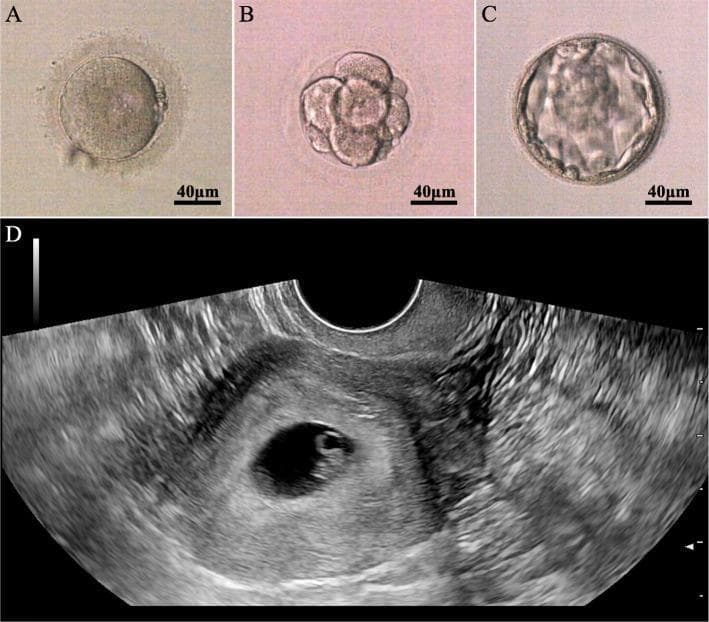 This four-panel image illustrates stages of human embryonic development following Intracytoplasmic Sperm Injection (ICSI). Panels A, B, and C are light microscopy images (scale bar 40 μm) depicting morphological progression: (A) shows a zygote with two pronuclei (2PN), indicating successful fertilization; (B) shows a cleavage-stage embryo at the 8-cell stage with distinct blastomeres; and (C) shows a blastocyst featuring an expanded blastocoel cavity, inner cell mass, and trophectoderm. Panel D is a transvaginal ultrasonogram of the uterus, demonstrating a clinical pregnancy. It shows a well-defined, anechoic gestational sac implanted within the thickened, echogenic endometrium. Inside the sac, a small echogenic structure consistent with a yolk sac or early fetal pole is visible. The composite image serves as an educational tool for reproductive medicine and embryology, highlighting the sequence from successful in vitro fertilization and embryo culture to clinical implantation in a patient with male-factor infertility.
