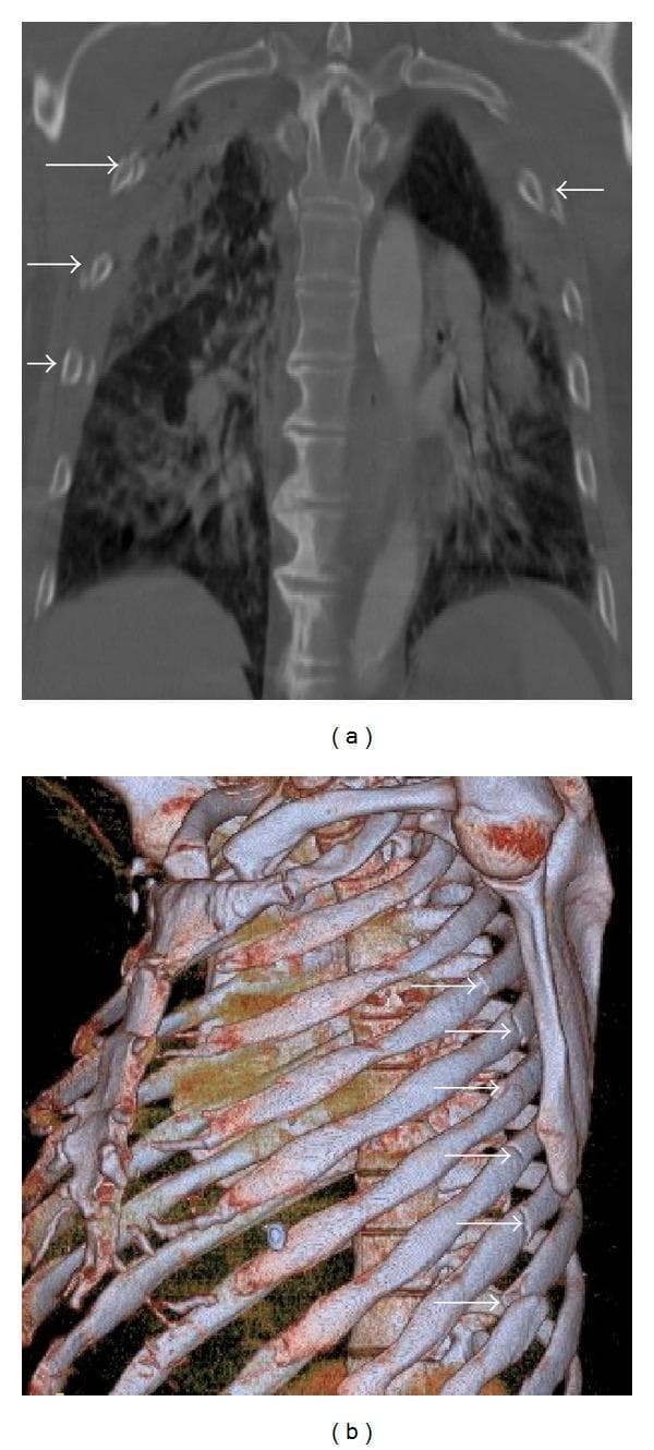 This composite diagnostic image showcases thoracic trauma findings using Multidetector Computed Tomography (MDCT). Figure (a) is a coronal CT reformat in a bone window demonstrating a 'flail chest' scenario. Multiple displaced rib fractures are identified by white arrows across consecutive costal arches on the right side and a single fracture on the left. The underlying lung parenchyma displays heterogeneous, patchy 'ground-glass' opacities and ill-defined consolidations, characteristic of pulmonary contusions resulting from blunt chest trauma. Figure (b) presents an oblique sagittal volume-rendering (3D) reconstruction of the thoracic cage. This visualization highlights the structural discontinuity of the thoracic wall, clearly demarcating a series of multiple rib fractures (indicated by arrows) along the posterior and lateral aspects of the left ribs. These images are essential for medical education regarding the radiological assessment of polytrauma, illustrating the relationship between skeletal injury (rib fractures) and parenchymal lung damage (contusions) in emergency radiology.
