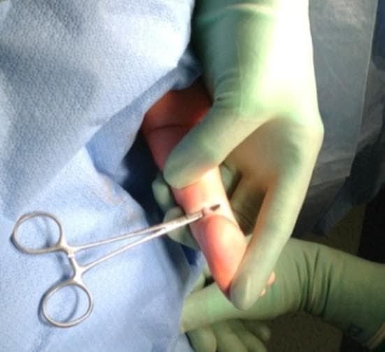 This clinical photograph captures a key intraoperative step of a mini-open Achilles tendon lengthening (TAL) procedure, typically performed as part of the Ponseti method for treating idiopathic clubfoot. The image shows a small, sterile surgical field draped in light blue cloth. A surgeon's hands, donned in green sterile gloves, are seen manipulating the posterior aspect of an infant's heel. A small (approximately 10 mm) medial incision has been made through which a metallic hemostat (mosquito clamp) is inserted. The clamp is positioned beneath the Achilles tendon, elevating and delivering it from the wound to allow for direct visualization. This step is critical to ensure the tendon is isolated from surrounding neurovascular structures, such as the tibial nerve and posterior tibial artery, prior to performing the tenotomy. The pale, fibrous texture of the tendon is visible at the tip of the instrument. The focus is on pediatric orthopedic surgical technique, emphasizing safety and direct visualization to prevent vascular or nerve injury during tendon release.