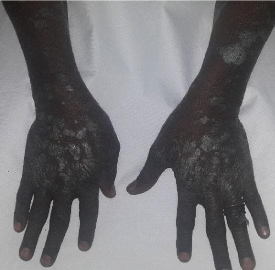 This clinical photograph displays widespread dermatological lesions on the dorsal and extensor surfaces of the hands and forearms of a patient with a dark skin phototype. The lesions present as a combination of well-demarcated, hyperpigmented plaques and raised papules covered with characteristic silvery-white, micaceous scales. On the dorsal aspect of the hands, the lesions are densely clustered, forming thick, rough, and confluent plaques that follow the anatomical contours of the metacarpals. On the forearms, the lesions appear larger, more discrete, and irregularly shaped, prominently featuring the silvery scaling against a background of post-inflammatory hyperpigmentation. The distribution on the extensor surfaces and the morphological features—specifically the silvery scale and plaque formation—are highly suggestive of chronic plaque psoriasis. This image serves as an educational tool for identifying typical psoriatic manifestations and observing how the condition appears in diverse skin tones, emphasizing the importance of recognizing silvery scales even when the underlying erythema may be masked by darker pigmentation.