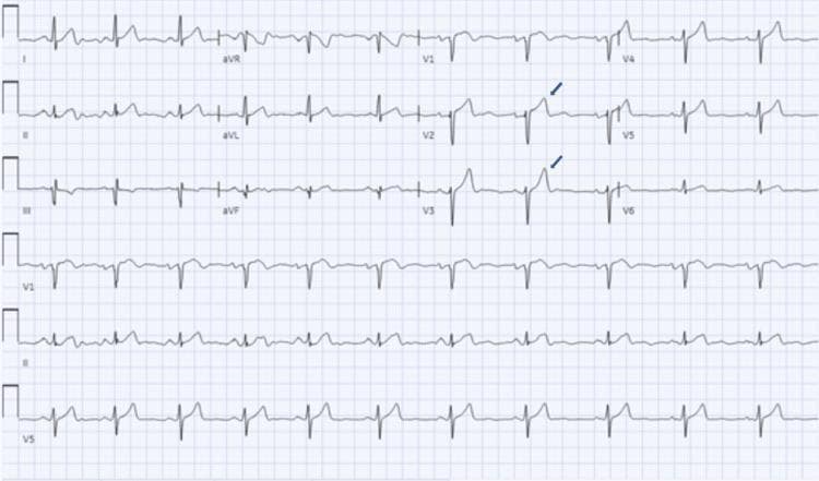 A 12-lead electrocardiogram (ECG) demonstrating a normal sinus rhythm with significant morphologic changes secondary to hyperkalemia (serum potassium 7.3 mmol/L). The tracing shows visible P waves and a consistent PR interval with narrow QRS complexes. The most prominent finding is the presence of tall, 'tented' or peaked T waves, most notably in the precordial leads V2 and V3 (indicated by blue arrows) and V4. These T waves exhibit a high amplitude and narrow base, which is a classic early electrocardiographic manifestation of elevated serum potassium. No ST-segment depression, P-wave flattening, or widened QRS (sine wave pattern) is currently visible, indicating an intermediate stage of hyperkalemic cardiotoxicity. This diagnostic image is an essential educational tool for identifying electrolyte imbalances and their impact on cardiac electrical activity, specifically for medical students and clinicians monitoring patients with acute kidney injury or metabolic disturbances.