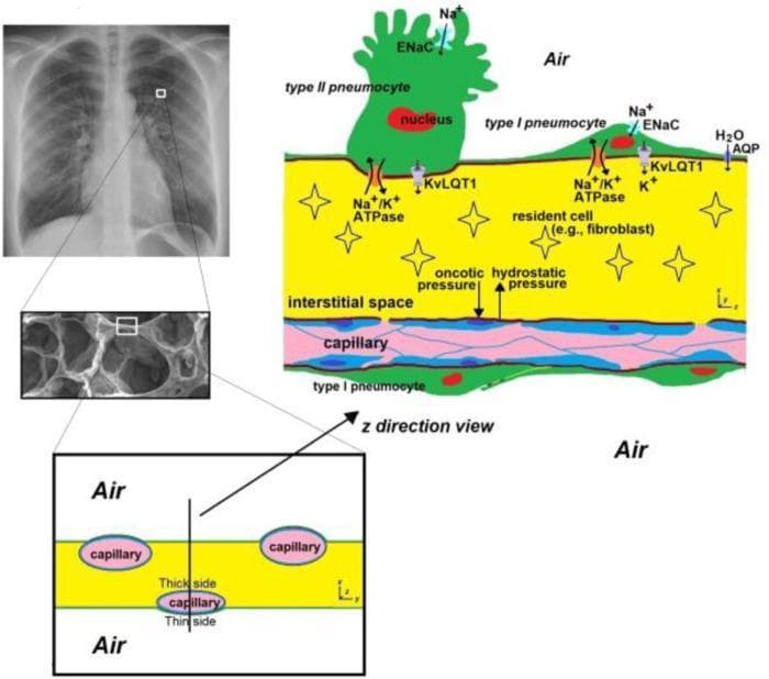 This composite educational graphic details the microanatomy of the human alveolar septa, combining a posterior-anterior chest radiograph, a microscopic view of lung parenchyma, and detailed pathophysiology schematics. The primary diagram illustrates the alveolar-capillary barrier, distinguishing between the 'thin side' optimized for gas exchange (where the epithelium and endothelium share a basal lamina) and the 'thick side' containing the interstitial space, extracellular matrix, and resident cells like fibroblasts. Key cellular components are depicted: cuboidal Type II pneumocytes with surfactant-secreting potential and thin, squamous Type I pneumocytes. The schematic identifies essential membrane proteins involved in fluid regulation and ion transport, including ENaC (sodium channels), Na+/K+ ATPase pumps, KvLQT1 (potassium channels), and AQP (aquaporins). Vectors demonstrate Starling forces, specifically oncotic and hydrostatic pressures, acting across the capillary wall. This visual is designed for advanced medical education in respiratory physiology, focusing on the structural heterogeneity of the alveolar wall and the mechanisms of fluid homeostasis and gas diffusion.