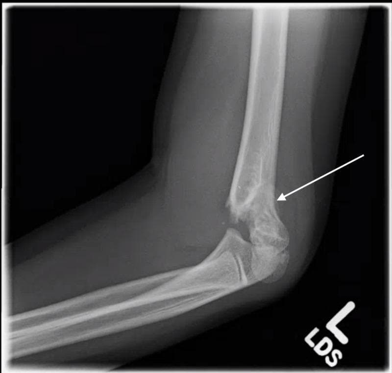 This diagnostic image is a lateral plain radiograph of the elbow in a pediatric patient, demonstrating a supracondylar fracture of the distal humerus, classified as a Gartland Type 2 fracture. A white arrow points to the fracture site at the supracondylar ridges. The radiograph shows a complete fracture with clear cortical disruption. There is a visible posterior displacement and posterior angulation of the distal humeral fragment relative to the humeral shaft. While the posterior cortex remains partially intact (hinged), providing the Type 2 classification, the normal anterior humeral line is disrupted and does not bisect the capitellum. The image also depicts associated soft tissue haziness consistent with swelling. This clinical image is highly relevant for pediatric orthopedics and emergency medicine, illustrating common mechanisms of injury such as a fall on an outstretched hand (FOOSH).