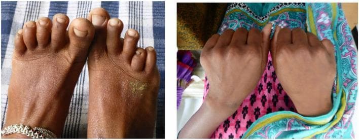 Two clinical photographs demonstrate structural hand and foot abnormalities in patients with sickle cell disease. The left image shows a dorsal view of the feet, highlighting a shortened fourth metatarsal on the right foot, which causes the fourth toe to appear significantly recessed compared to the third and fifth digits. The right image displays a dorsal view of both hands, where the right fifth metacarpal is noticeably shortened, resulting in a proximally displaced fifth digit (pinky finger). These findings illustrate the clinical sequelae of dactylitis (hand-foot syndrome), where vaso-occlusive crises or secondary infection in childhood lead to premature epiphyseal fusion and arrested longitudinal bone growth. This visual evidence serves as a diagnostic indicator of past severe vaso-occlusive events in patients with homozygous sickle cell (HbSS) disease or other sickle cell variants common in South Asian populations.
