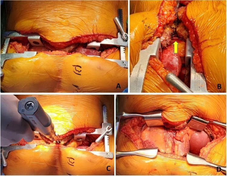 This composite of clinical photographs illustrates the surgical incision and exposure techniques for a clamshell incision (bilateral antero-lateral thoracotomy) during a lung transplant or major thoracic procedure. Panel A shows the initial bilateral thoracotomies with a Wilson rib retractor positioned to widen the intercostal spaces, viewed from the head end. Panel B provides a detailed view of the right internal mammary vessels, which have been ligated with surgical clips (indicated by a yellow arrow) to prevent hemorrhage. Panel C demonstrates the performance of a midline sternotomy using a surgical power drill to divide the sternum, connecting the bilateral thoracotomies. Panel D displays the final surgical exposure with Tuffier retractors in place, providing a wide field of view that reveals the underlying thoracic structures and an elevated right diaphragmatic dome. The sequence highlights the progression from intercostal dissection to full sternal division and wide retraction for optimal hilar access.