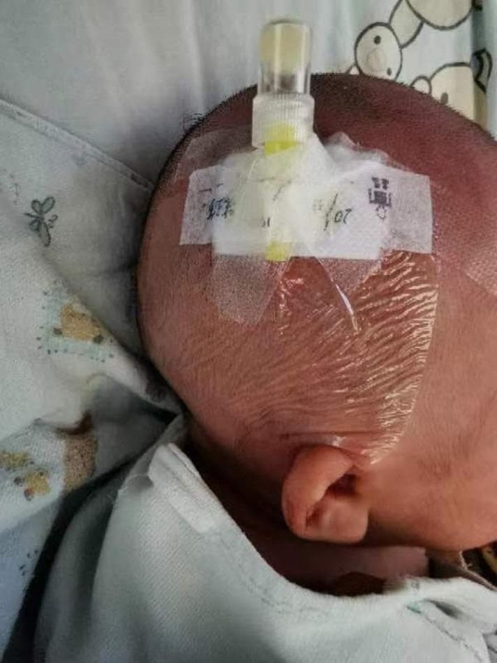 This clinical photograph shows a close-up of a pediatric scalp demonstrating the securement and fixation of a scalp vein indwelling needle (peripheral intravenous catheter). The device is inserted into the right superficial temporal vein of an infant, whose right ear and shaved scalp with fine stubble are visible in the frame. The catheter hub is constructed of transparent plastic with a yellow-capped proximal Luer lock connector. To ensure stability, the hub is anchored to the skin using white, opaque medical adhesive tape strips applied in a criss-cross pattern. A large, transparent semi-permeable adhesive film (Tegaderm-style dressing) is applied over the entire insertion site and tape, providing a sterile barrier and further reinforcing the device. The background shows patterned pediatric bedding, suggesting a hospital ward environment. This image serves as an educational example of standard procedural fixation techniques for neonatal and infant intravenous access to prevent accidental dislodgement or catheter fracture.