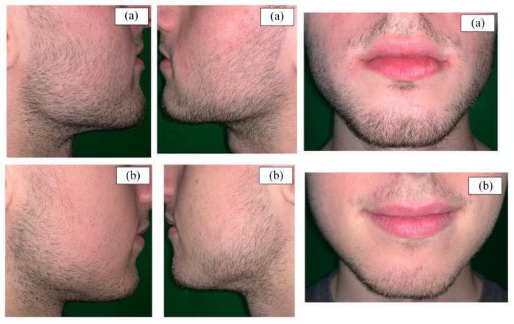This clinical photograph comparison presents six views of facial hair growth in a study involving identical twins to evaluate the efficacy of topical minoxidil. The images are divided into two rows: (a) shows the treatment subject after 16 months of daily 5% minoxidil foam application, and (b) shows the non-treated control subject. Both individuals are photographed 10 days post-shave. Row (a) demonstrates a significantly higher follicular density, increased hair shaft thickness, and more extensive terminal hair coverage across the beard, mustache, and cheek regions. In contrast, row (b) exhibits sparser, finer, and patchier hair distribution. The comparison highlights the pharmacological effect of minoxidil on prolonging the anagen phase and increasing follicular size in androgen-sensitive facial areas. Key anatomical focuses include the submandibular region, malar area, and perioral region. This visual is intended for dermatological education regarding hair loss treatments and off-label uses of minoxidil for facial hair enhancement.