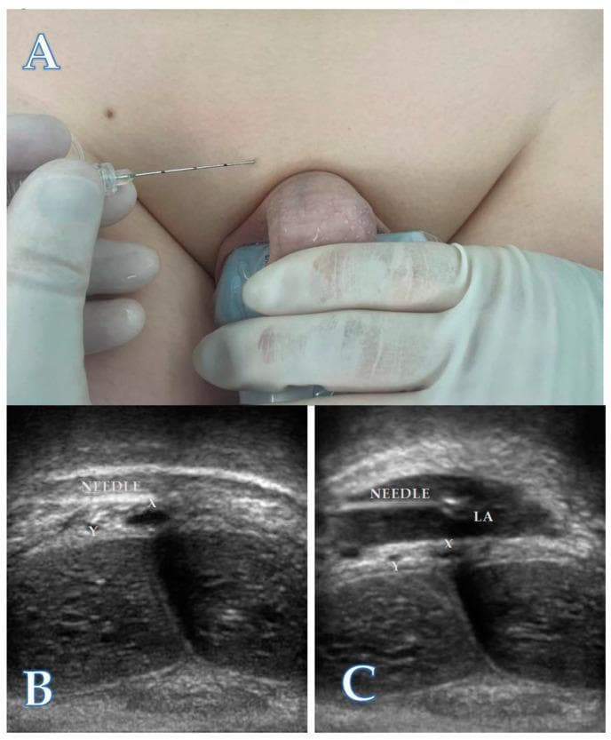 This composite educational image illustrates the technique for an ultrasound-guided dorsal penile nerve block (DPNB). Panel A is a clinical photograph demonstrating the patient positioning and probe placement. A linear ultrasound transducer is positioned in a coronal plane at the base of the penis, while a 22-gauge needle is being advanced using an in-plane, lateral-to-medial approach. Panels B and C are corresponding ultrasound scans. Panel B shows the pre-injection anatomy of the neurovascular bundle, identifying the deep dorsal penile vein (X) and dorsal penile arteries (Y) located deep to Buck's fascia. The needle tip is visible approaching these structures. Panel C demonstrates the post-injection state, where a well-defined hypoechoic area (LA) indicates the successful distribution of local anesthetic within the neurovascular sheath, surrounding the vein (X) and arteries (Y). This visualization confirms correct drug placement for anesthesia during procedures like circumcision. The content is designed for intermediate medical trainees learning regional anesthesia and pediatric urology techniques.