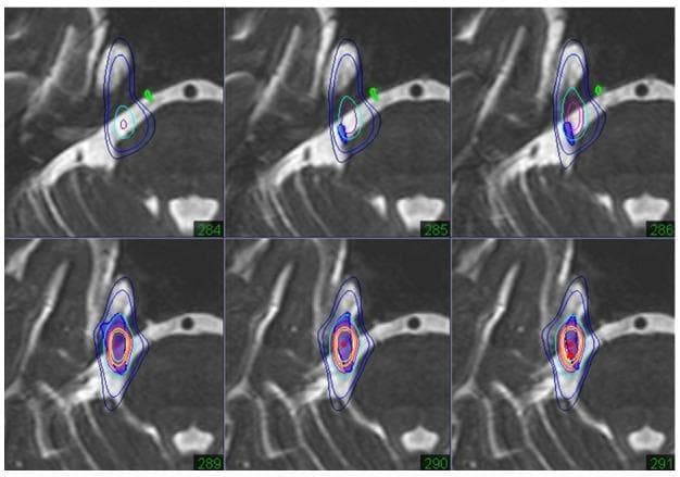 This diagnostic image sequence consists of six axial slices (284–291) showing fused heavy T2-weighted MRI and thin-slice CT for radiosurgery planning in a case of trigeminal neuralgia. The images visualize the trigeminal nerve complex, including the pre-ganglion portion, Gasserian ganglion, and retro-ganglion portion at the petrous apex. Superimposed on the anatomy are color-coded isodose lines representing radiation dose distribution. The prescribed target area is the retro-ganglion portion, indicated by high-intensity red and orange central isodose lines that expand and intensify from slice 289 to 291. Surrounding blue and light blue lines delineate lower dose gradients. A critical anatomical feature, the abducens nerve (highlighted in green), is visible and positioned outside the prescribed isodose range to ensure functional preservation. The fused imaging provides the high-contrast soft tissue detail of T2-MRI for nerve identification and the high-density bone detail of CT for spatial orientation, facilitating precise stereotactic targeting for neurosurgical treatment.